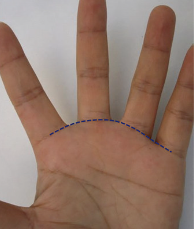 lesões da comissura