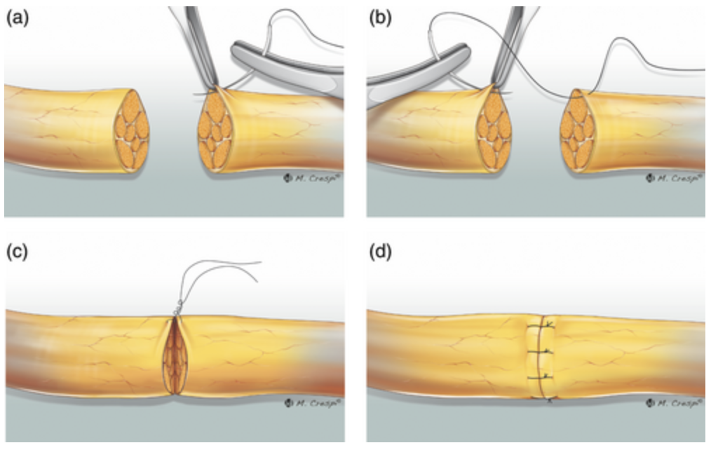 lesão do nervo digital