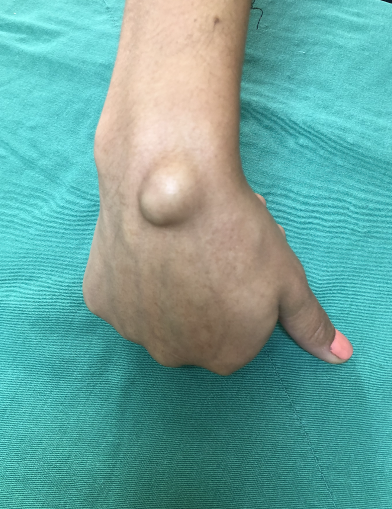 cisto artrossinovial