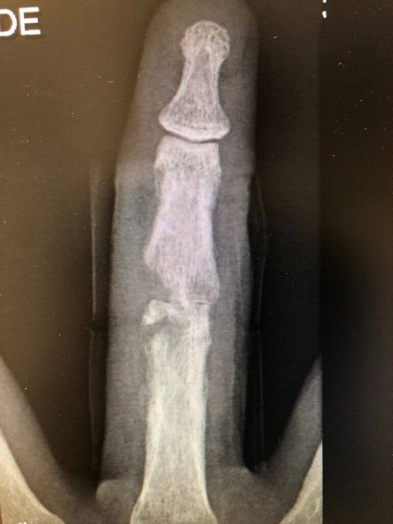 osteomielite por mordedura