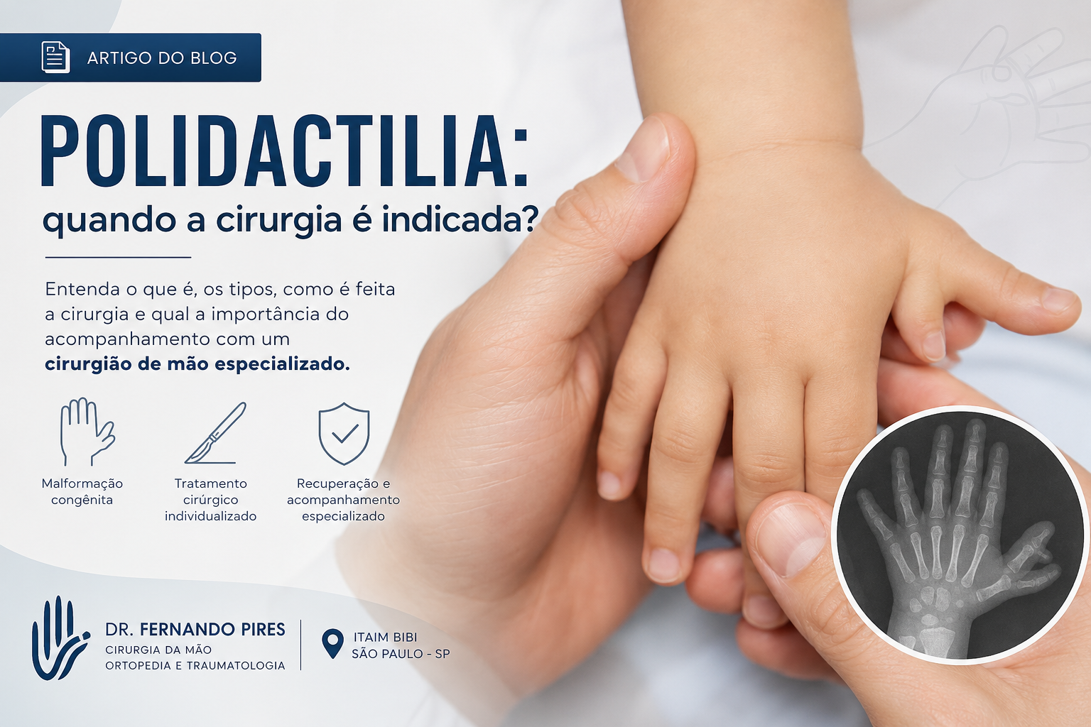 polidactilia