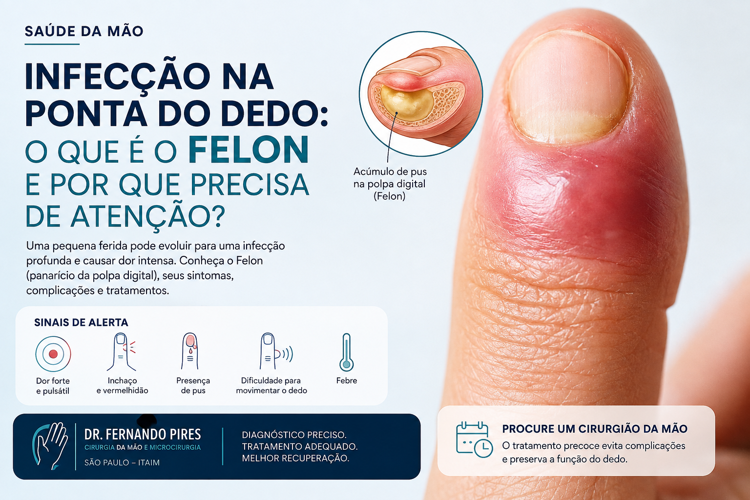 Infecção de ponta de dedo
